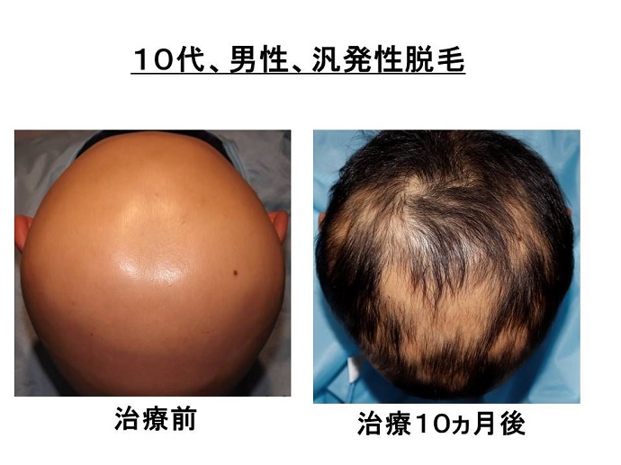 円形脱毛症　病院